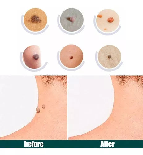 🔝LUMINIIX → ELIMINADOR DE VERRUGAS