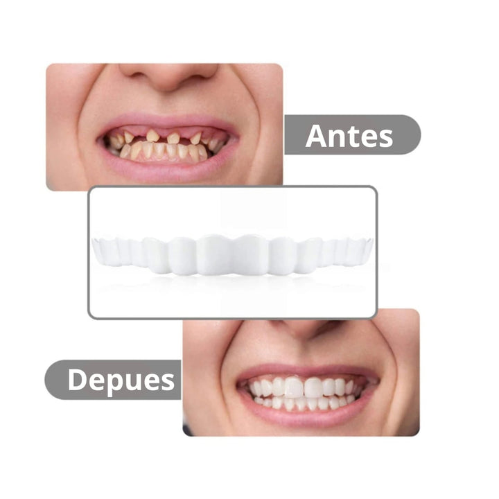 Carillas Postiza Dentadura SnapOn Smile