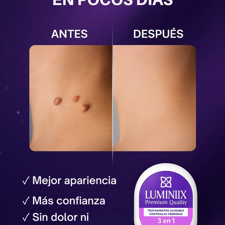 🔝LUMINIIX → ELIMINADOR DE VERRUGAS